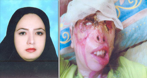 مهم ترین قربانیان اسیدپاشی در ایران... (18+)