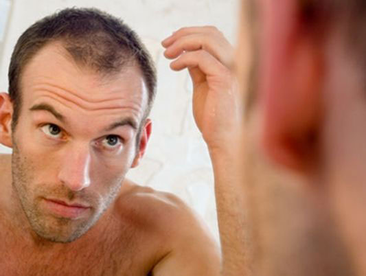 چرا موهای مردها می‌ریزد؟