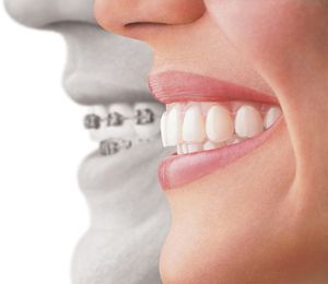 بهترین سن برای ارتودنسی دندان