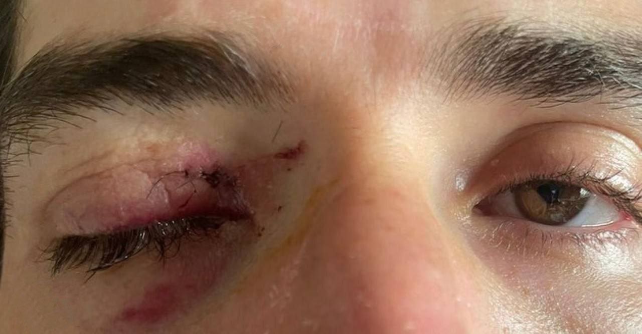 تصویر چشم زخمی انصاری‌فرد پس از جشن تولد 