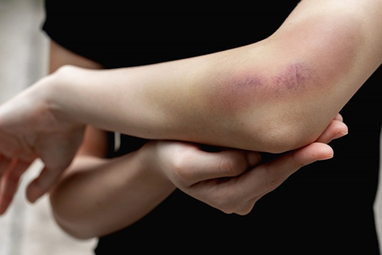 کبودی بی‌دلیل پوست؛ شاید برای شما هم اتفاق بیفتد