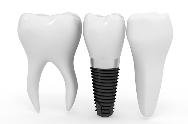 دکتر امینی - ایمپلنت جایگزینی برای دندان