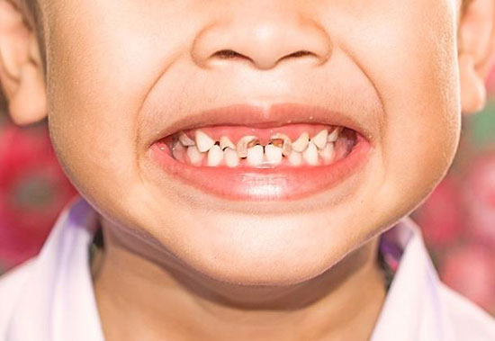نکاتی که باید درباره پوسیدگی دندان بدانید