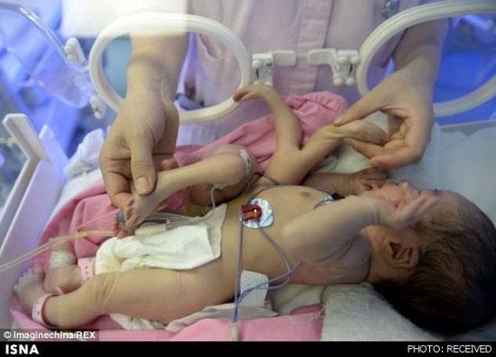 عکس: نوزادِ 8 دست‌ و پا