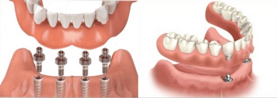 دندان مصنوعی ثابت چیست و قیمت آن چقدر است؟