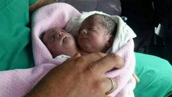 تولد نوزاد 2 سر در سوریه
