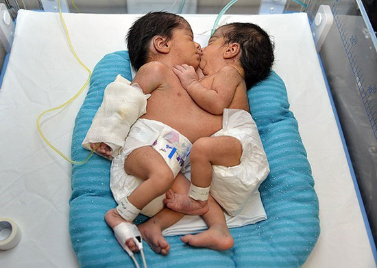 عکس: تولد دو قلوی به‌ هم چسبیده در شیراز