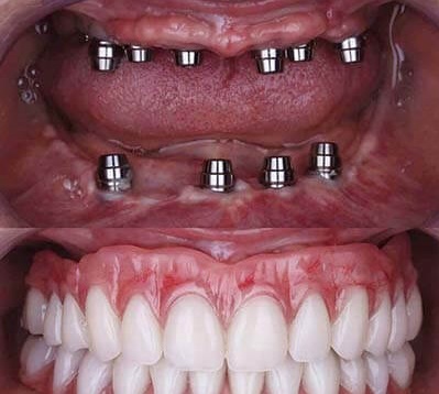مزیت‌های ایمپلنت دندان