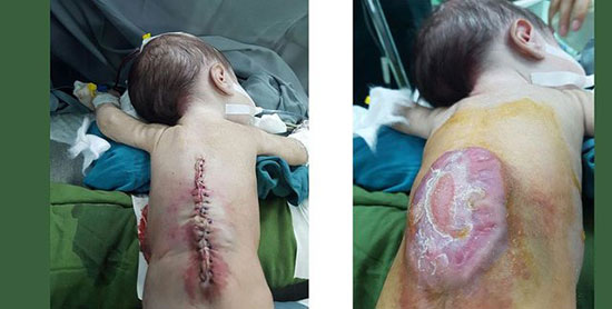 جراحی موفق «میلومننگوسل» یک نوزاد در سمنان