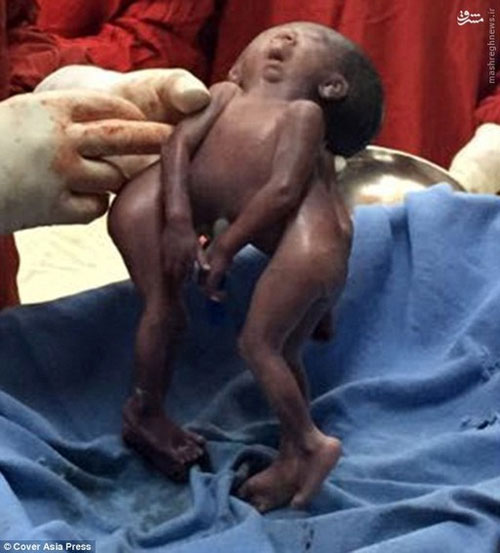 عکس: تولد نوزاد دوقلو با یک صورت (18+)