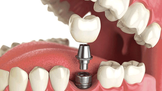 پروتزهای دندانی؛ انواع و قیمت آن‌ها