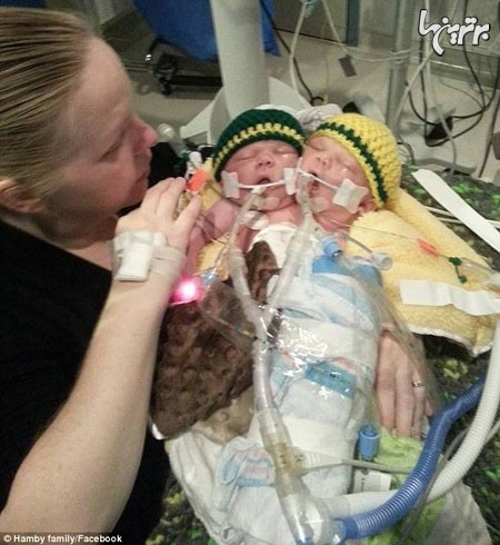 تولد نوزادِ دو سر در انگلستان +عکس