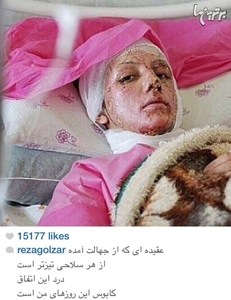 چهره ها پس از اسید پاشی‌های اصفهان