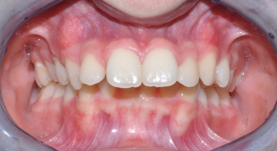 ارتودنسی یا کامپوزیت؟ برای دندان شما کدام بهتر است؟