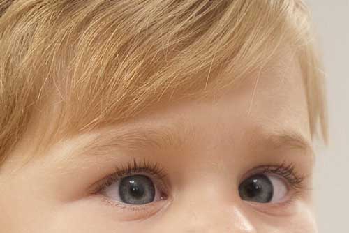 تنبلی چشم؛ دلیل نارسایی بینایی در کودکان