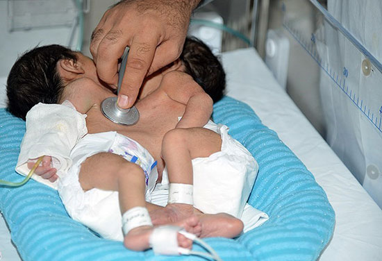 عکس: تولد دو قلوی به‌ هم چسبیده در شیراز