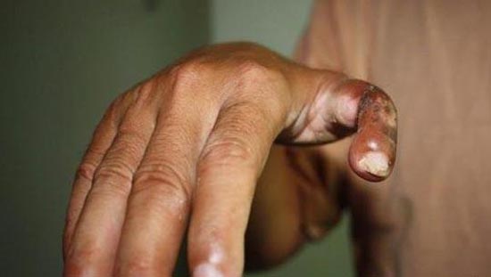 پیوند انگشت پا به شست دست! +عکس