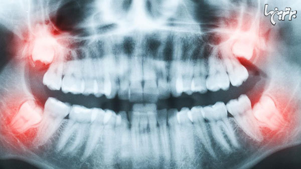 علت رشد دندان عقل چیست؟ 