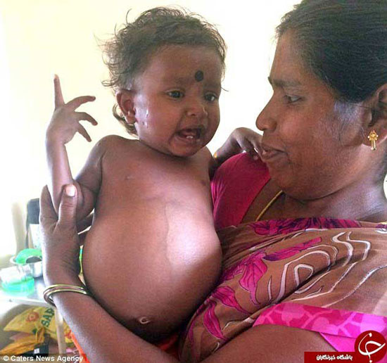 نوزاد دختر هنگام تولد، دوقلو باردار بود!