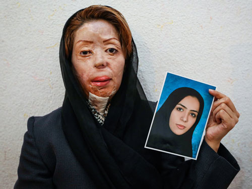 مهم ترین قربانیان اسیدپاشی در ایران... (18+)