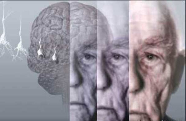 کشف عامل بروز آلزایمر