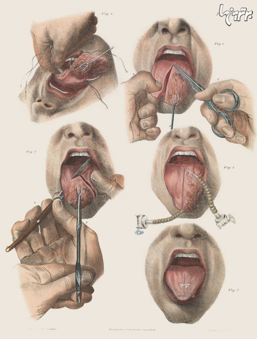 عمل های جراحی در قرن نوزدهم +عکس