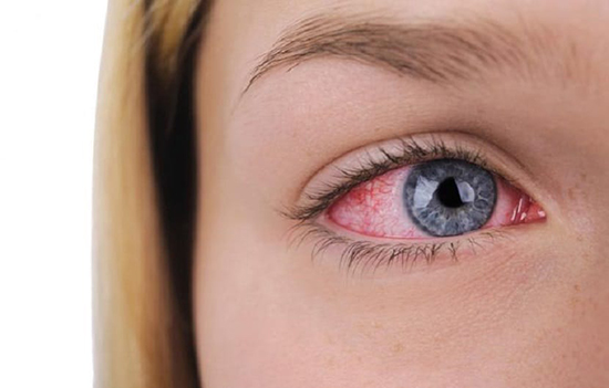 خشکی چشم چیست و چه نشانه‌هایی دارد؟