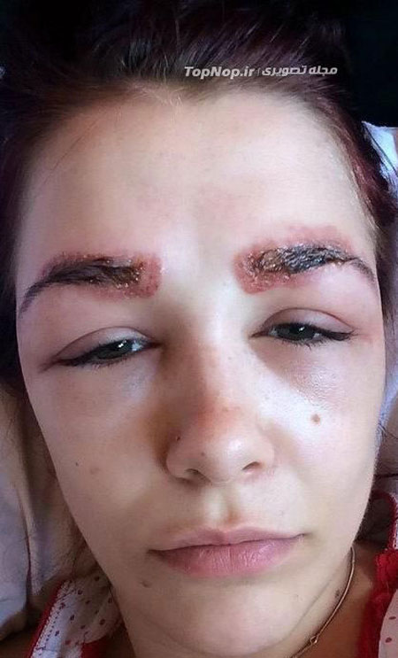دختر 19 ساله، قربانی عمل زیبایی +عکس