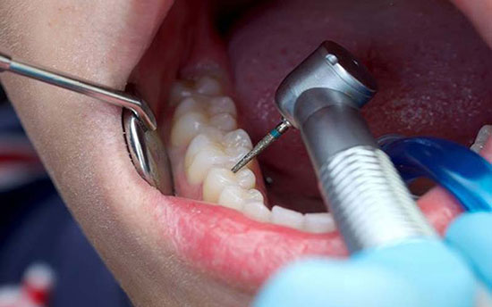 عصب کشی دندان و سوالات رایج درباره آن