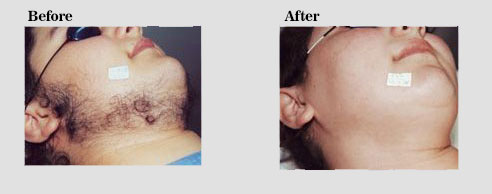 لیزر مو با 3 دستگاه پیشرفته ، توسط متخصص پوست و مو