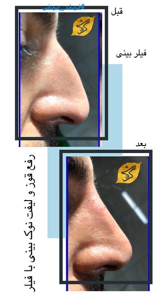 انواع تزریق به بینی (تزریق ژل، تزریق فیلر و ..) + مزایا و عوارض