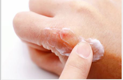 روش‌هایی برای حفاظت از پوست در سرما
